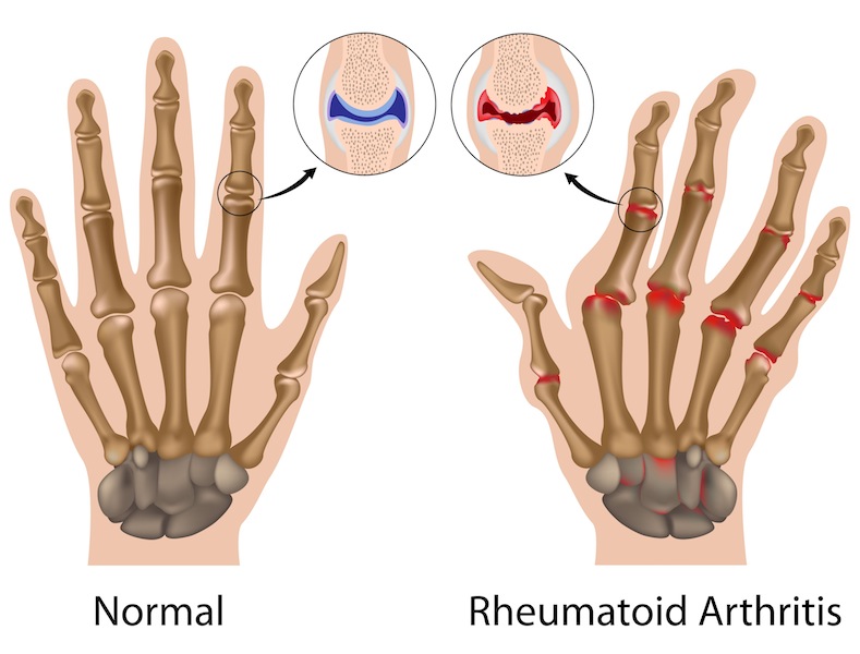 artrite-reumatoide-sintomi.jpg