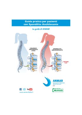 LA SPONDILITE ANCHILOSANTE